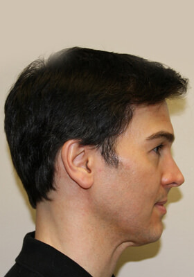 hair transplant photos