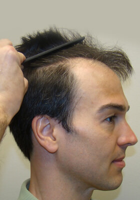 hair transplant photos