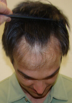 hair transplant photos