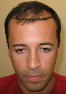 hair transplant photos