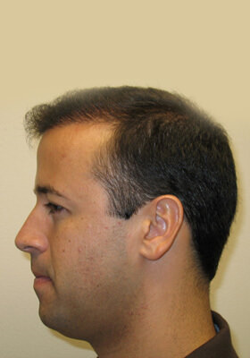 hair transplant photos