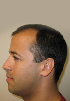 hair transplant before after Photos