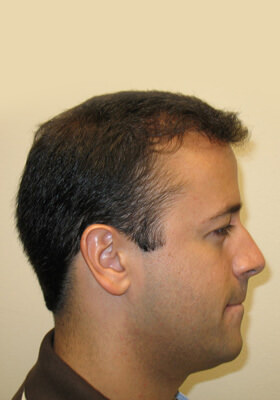 hair transplant photos