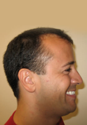 hair transplant before after Photos