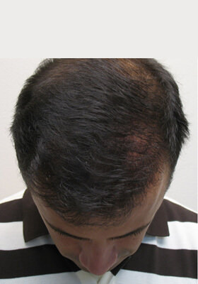 hair transplant photos