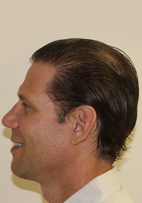 hair transplant before after Photos