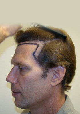 hair transplant photos