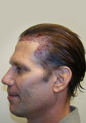 hair transplant photos