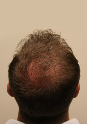 hair transplant before after Photos