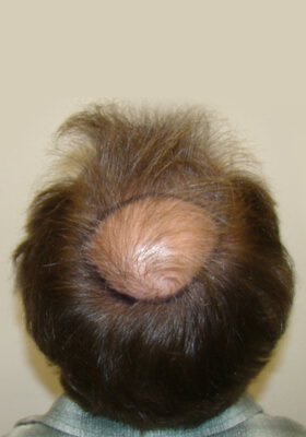 hair transplant before after Photos