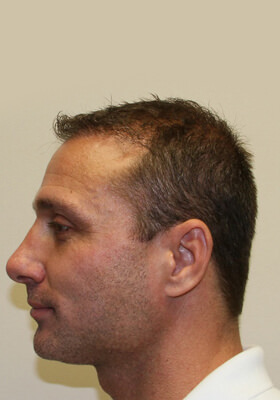 hair transplant before after Photos