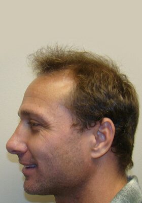 hair transplant before after Photos