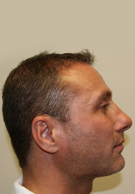 hair transplant photos