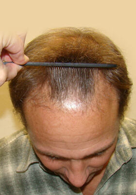 hair transplant photos