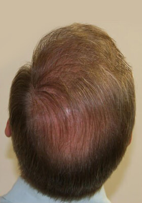 hair transplant photos