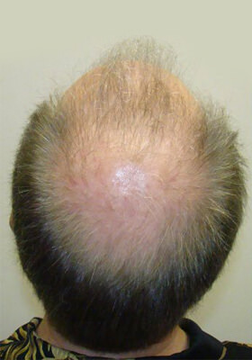 hair transplant photos