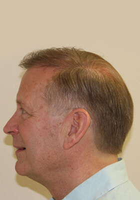 hair transplant photos