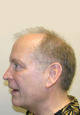 hair transplant photos