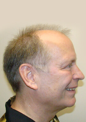 hair transplant before after Photos