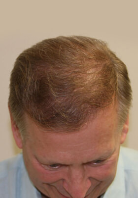 hair transplant photos