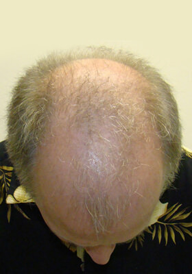 hair transplant photos