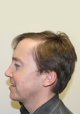 hair transplant before after Photos