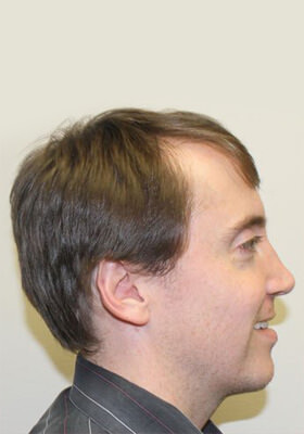 hair transplant photos