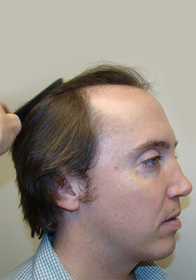 hair transplant before after Photos