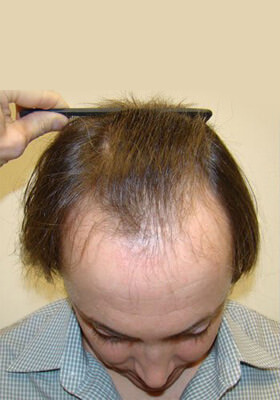 hair transplant before after Photos