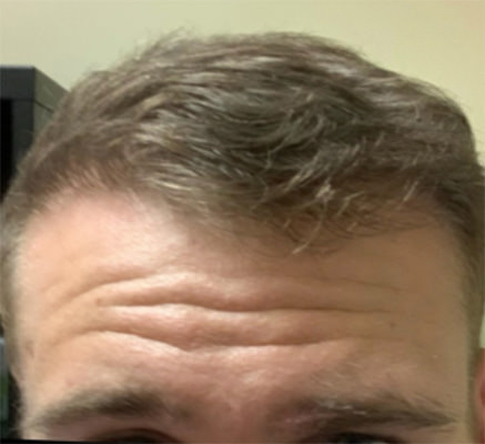 hair transplant photos