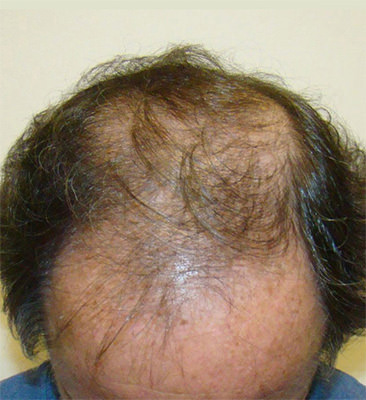 hair transplant photos