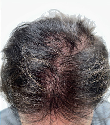 hair transplant photos