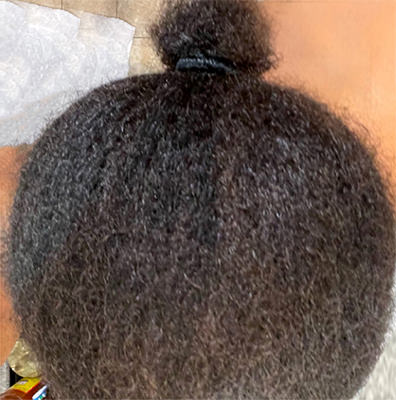 hair transplant photos