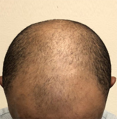 hair transplant photos