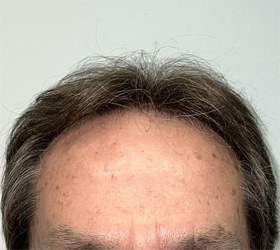 hair transplant photos