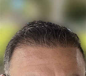 hair transplant photos