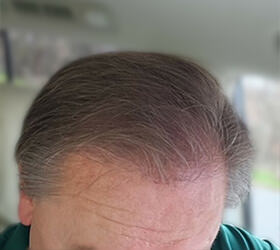 hair transplant photos