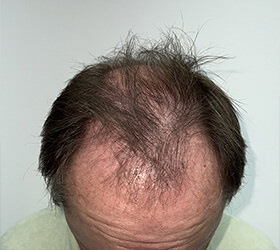 hair transplant photos