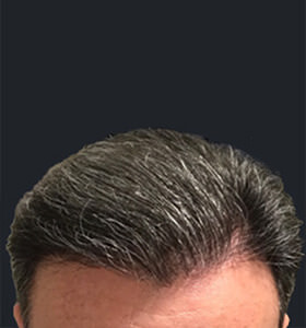 hair transplant photos