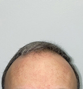 hair transplant photos