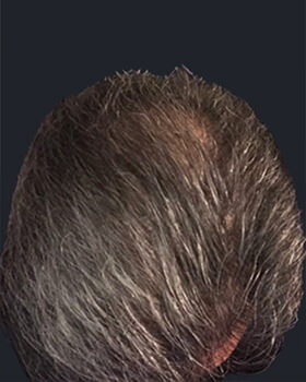 hair transplant photos