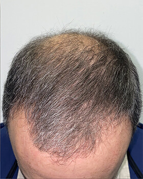 hair transplant photos