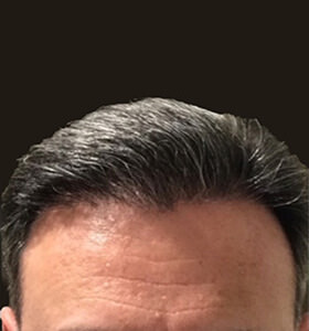 hair transplant photos