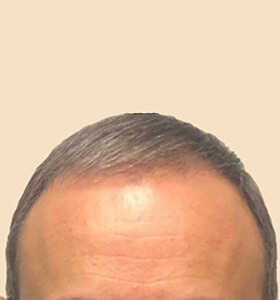 hair transplant photos