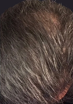 hair transplant photos