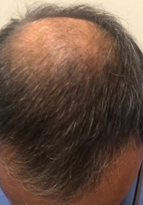 hair transplant photos