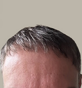 hair transplant photos