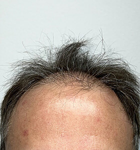 hair transplant photos