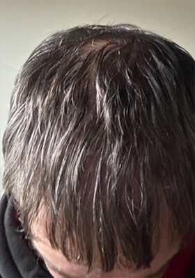 hair transplant photos