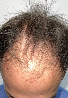 hair transplant photos